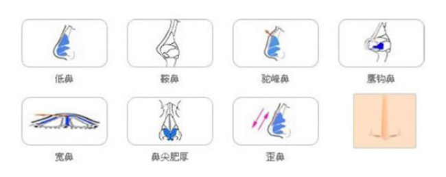 鼻部综合整形专业美容医院