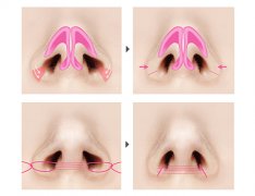 鼻翼缩小和鼻头缩小的区别