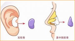 自体隆鼻优点有哪些