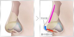 想做软骨隆鼻去哪好?