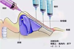 注射隆鼻这种方法可行吗