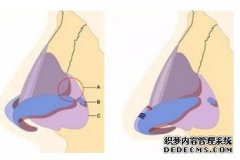 永康医院假体隆鼻哪种材料好